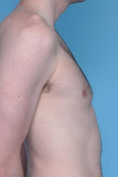 After image 1 Case #81176 - Male Breast Reduction