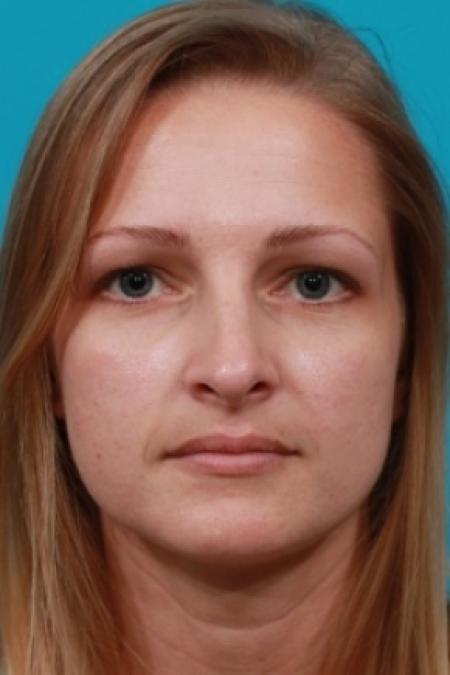After image 1 Case #78781 - Rhinoplasty (Nose Reshaping)