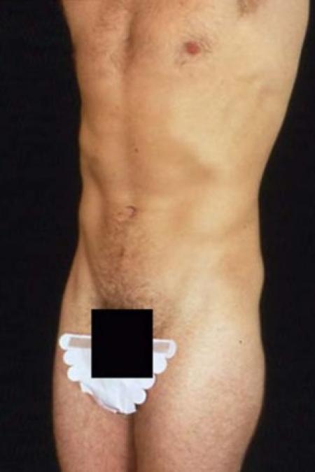 After image 1 Case #81526 - Liposuction