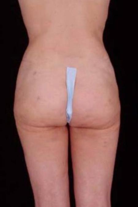 After image 4 Case #81666 - Liposuction