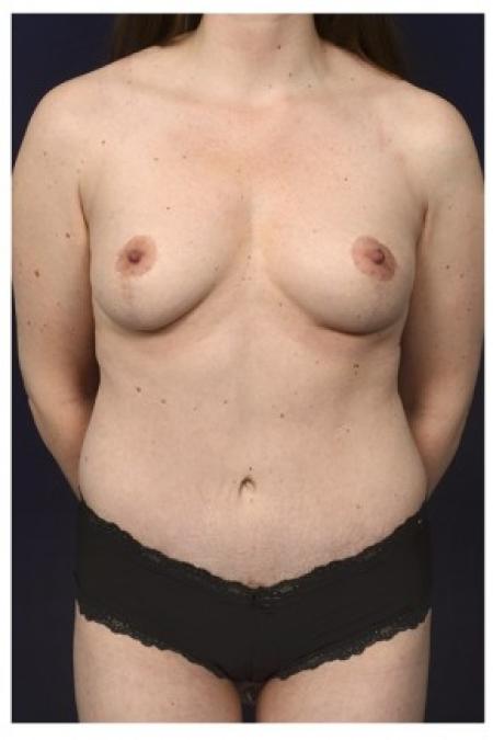 After image 1 Case #85571 - Mommy Makeover