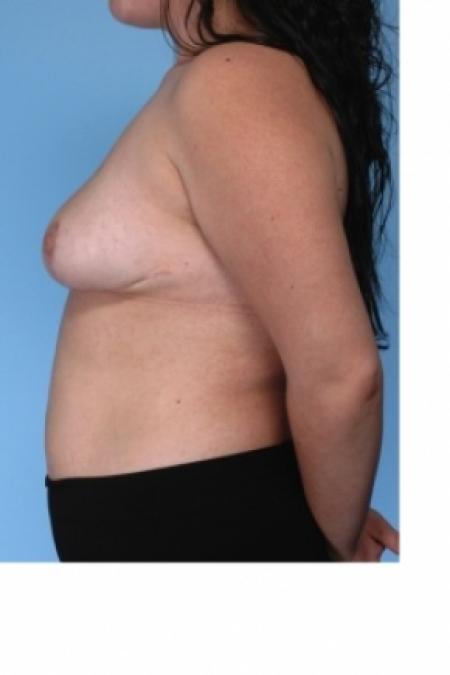 After image 3 Case #80601 - Breast Reduction