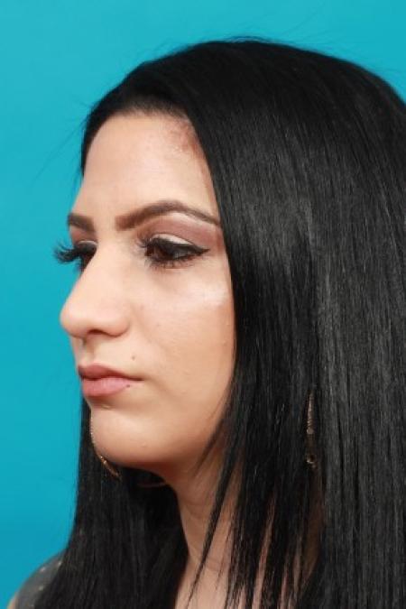 After image 2 Case #83921 - Rhinoplasty with Chin Augmentation