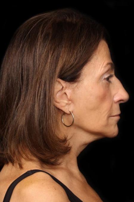 After image 3 Case #88126 - Facelift with Peri-Occular Laser Resurfacing