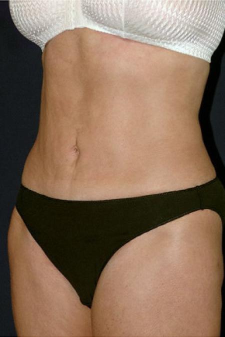 After image 2 Case #102936 - Abdominoplasty
