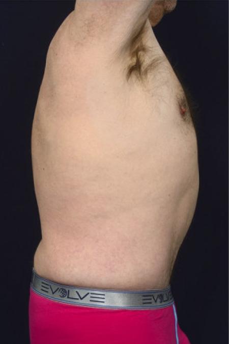 After image 2 Case #102946 - Abdominoplasty