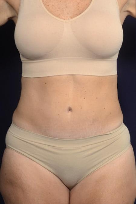After image 1 Case #102441 - Abdominoplasty