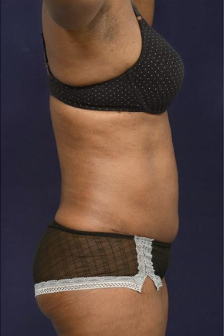 After image 3 Case #102941 - Abdominoplasty