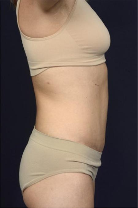 After image 3 Case #102381 - Abdominoplasty