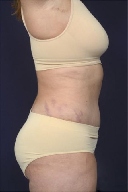 After image 3 Case #102591 - Abdominoplasty