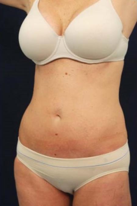 After image 2 Case #102861 - Abdominoplasty