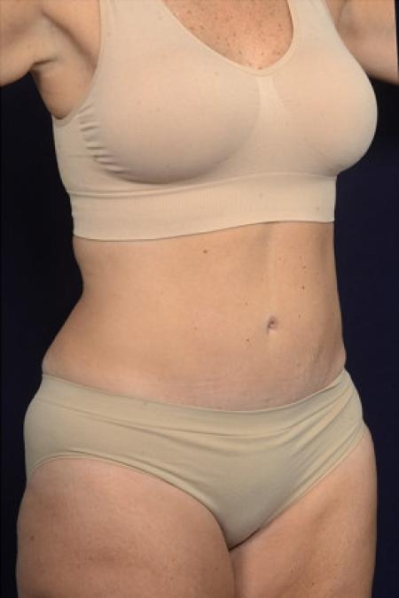 After image 2 Case #102441 - Abdominoplasty