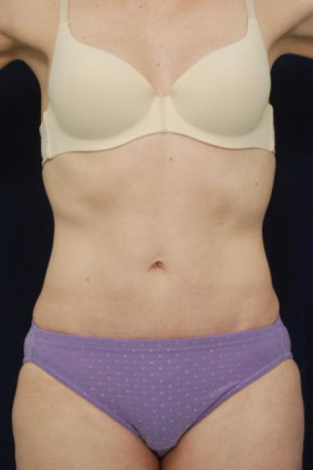 After image 1 Case #102846 - Abdominoplasty