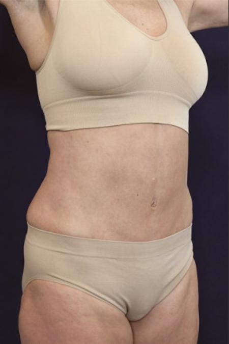 After image 2 Case #102406 - Abdominoplasty