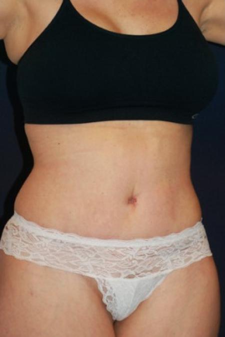 After image 2 Case #102856 - Abdominoplasty