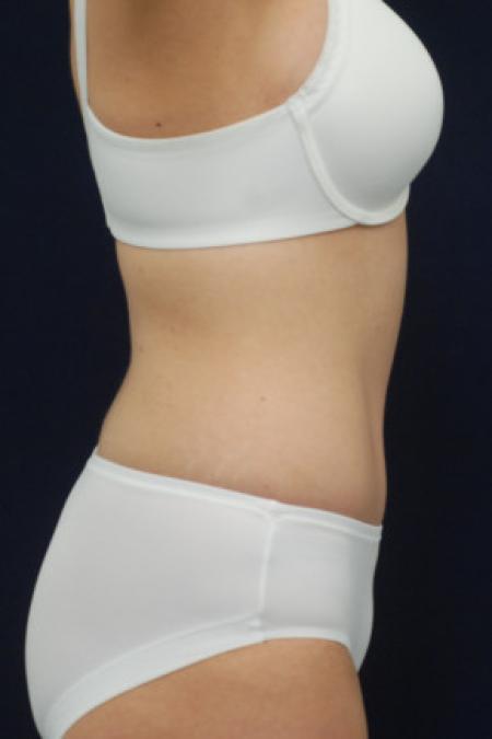 After image 3 Case #102851 - Abdominoplasty