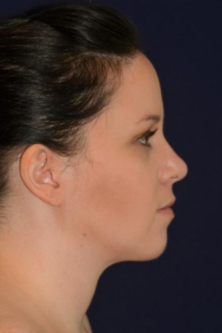 After image 3 Case #102631 - Neck Lift