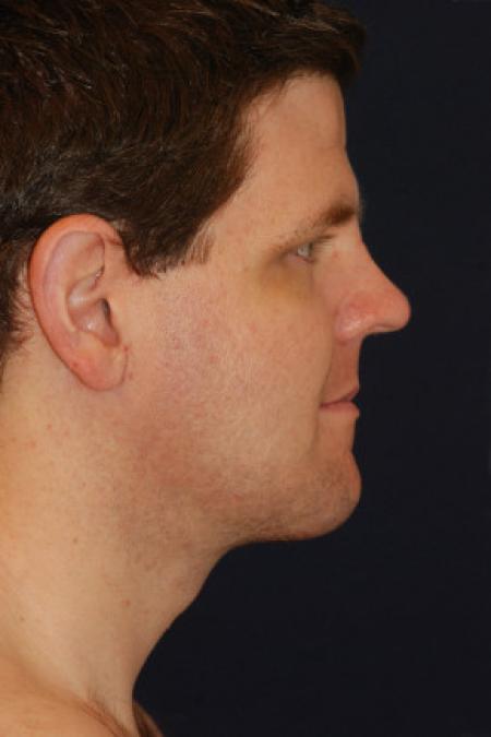 After image 3 Case #102791 - Neck Lift