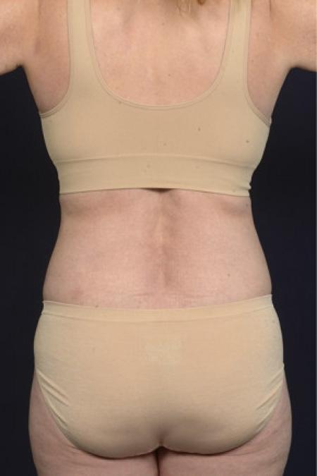 After image 3 Case #102486 - Liposuction