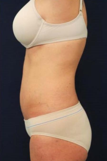 After image 3 Case #102861 - Abdominoplasty