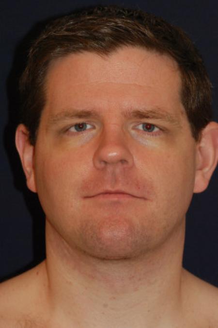 After image 1 Case #102791 - Neck Lift