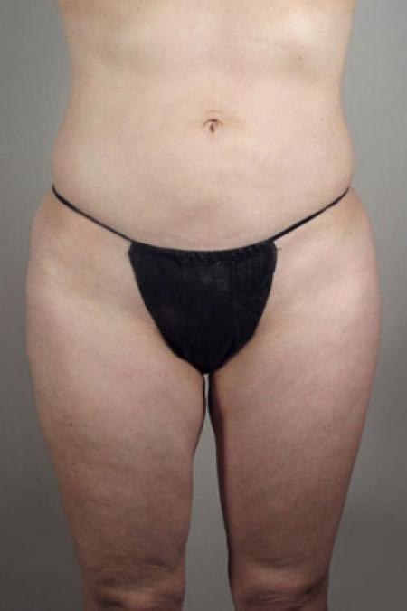 After image 4 Case #103191 - Upper Arm and tummy Liposuction Patient 13