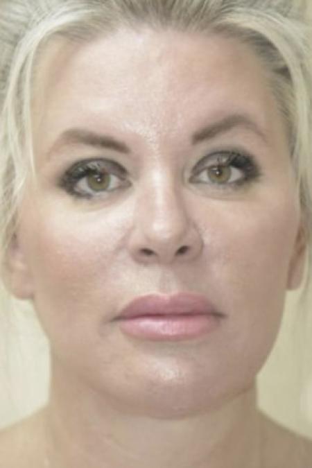 After image 1 Case #103116 - Facelift/ Blepharoplasty 