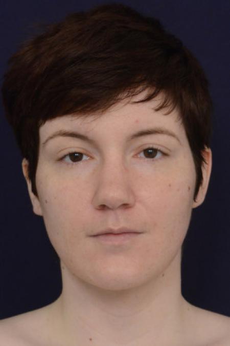 After image 1 Case #102796 - Neck Lift