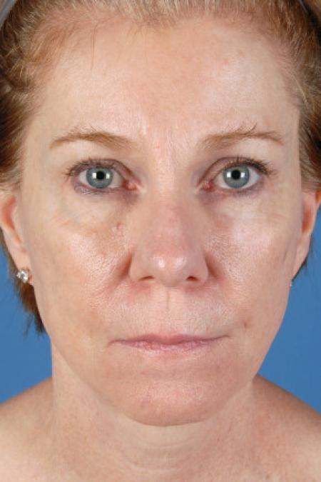 After image 1 Case #102146 - Facelift - 57-year-old woman