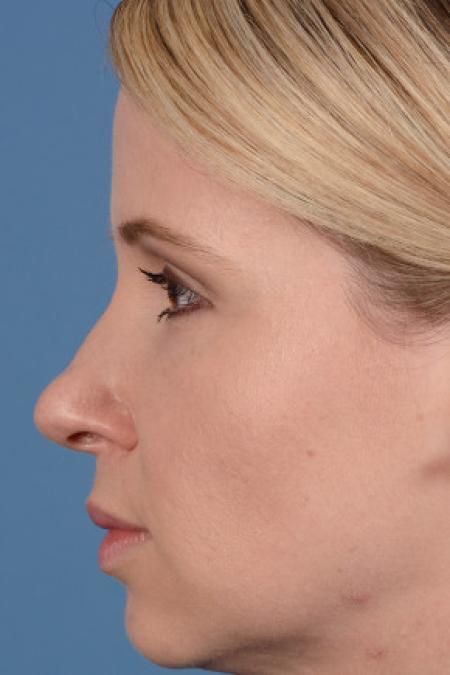 After image 3 Case #102156 - Dermal Fillers - 33-year-old woman