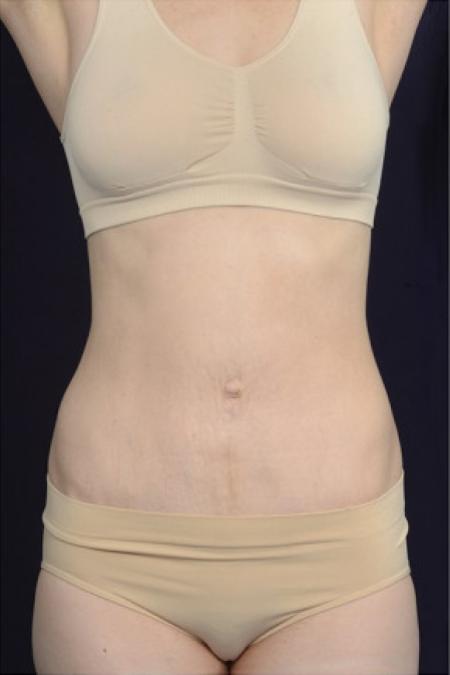 After image 1 Case #102951 - Abdominoplasty