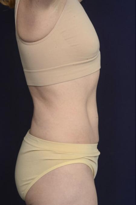 After image 3 Case #102546 - Liposuction