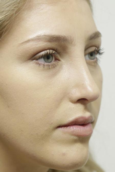 After image 2 Case #103376 - Endonasal Closed ("Scarless") Rhinoplasty
