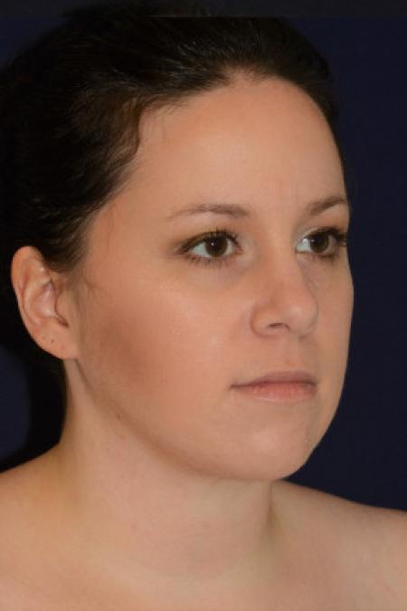 After image 2 Case #102631 - Neck Lift