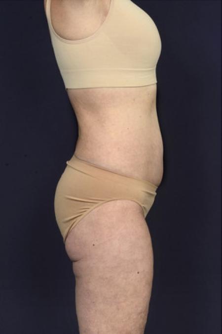 After image 3 Case #102456 - Liposuction