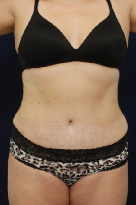 After image 1 Case #102886 - Abdominoplasty
