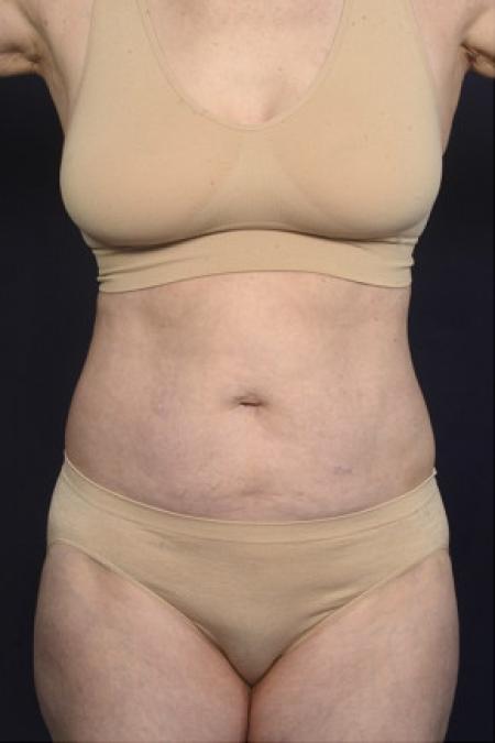 After image 1 Case #102486 - Liposuction