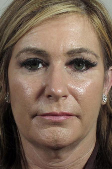 After image 1 Case #103156 - Rhinoplasty Patient 64