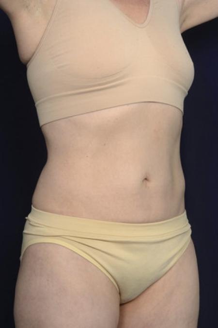 After image 2 Case #102546 - Liposuction