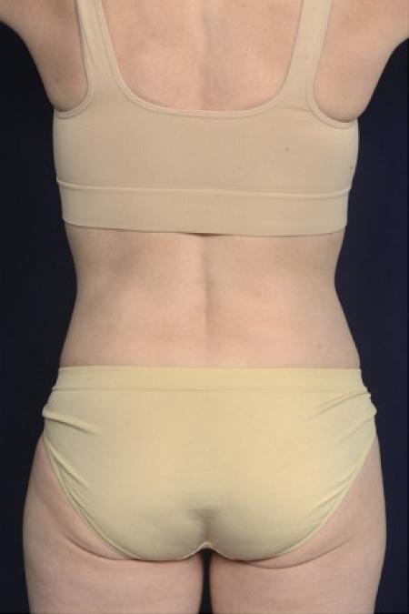 After image 4 Case #102546 - Liposuction