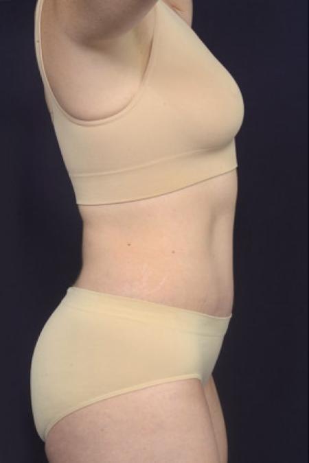 After image 3 Case #102956 - Abdominoplasty