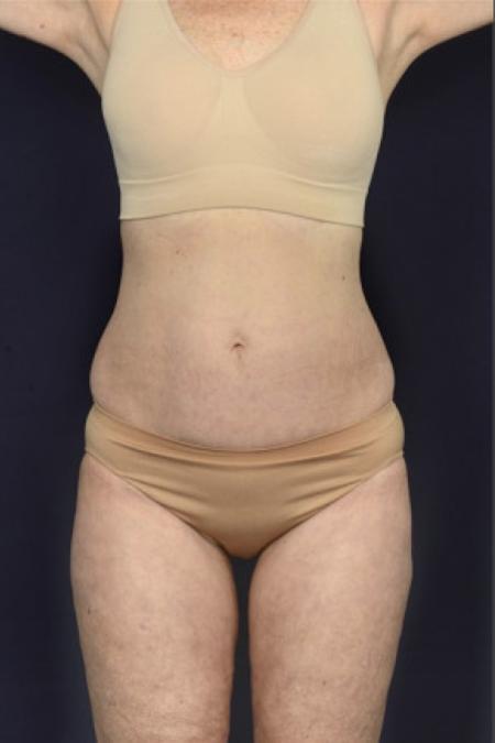 After image 1 Case #102456 - Liposuction