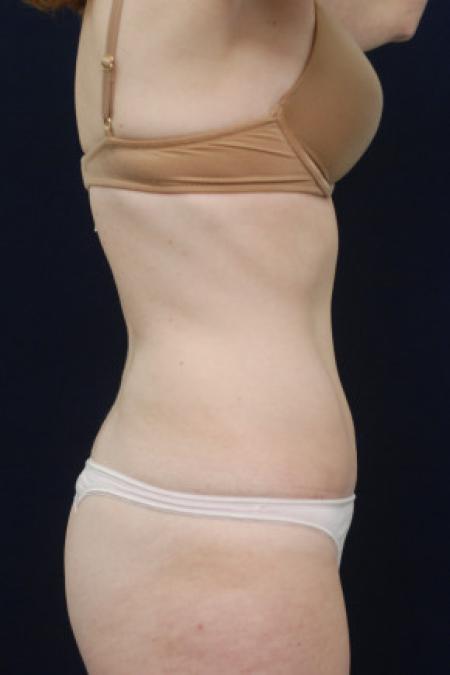 After image 3 Case #102836 - Abdominoplasty