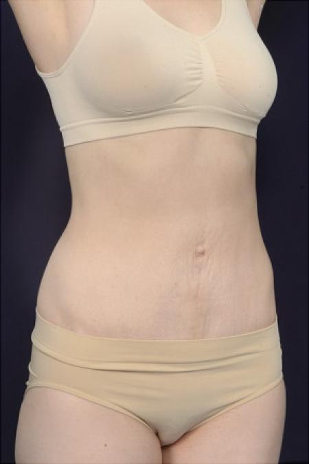 After image 2 Case #102951 - Abdominoplasty
