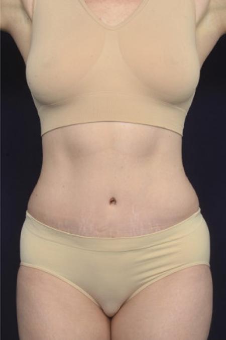 After image 1 Case #102956 - Abdominoplasty