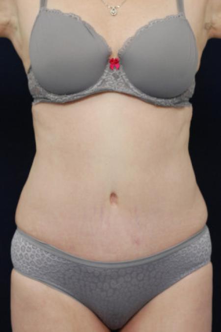 After image 1 Case #102841 - Abdominoplasty
