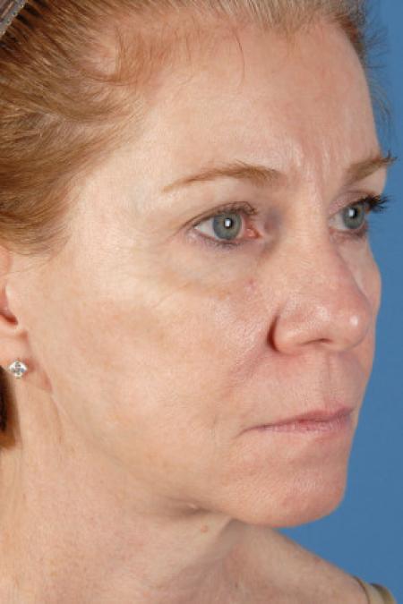 After image 2 Case #102146 - Facelift - 57-year-old woman