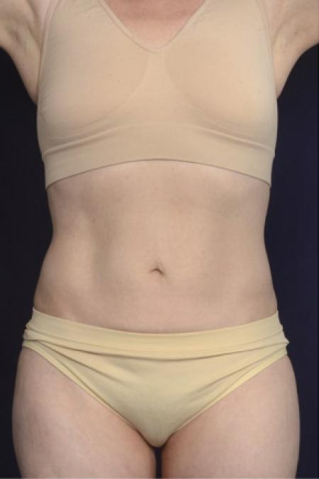 After image 1 Case #102546 - Liposuction