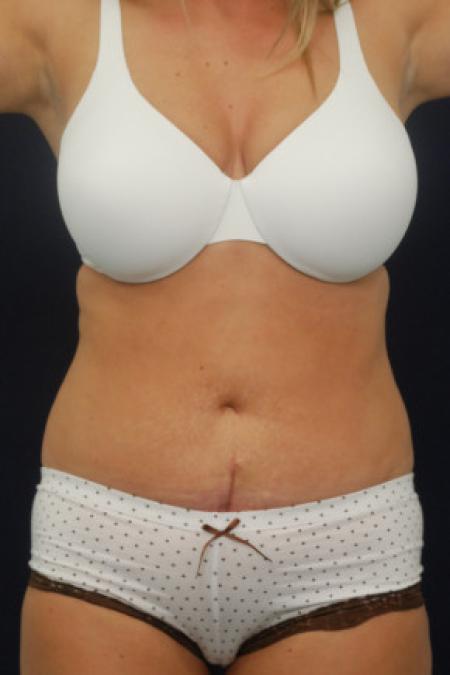 After image 1 Case #102901 - Abdominoplasty