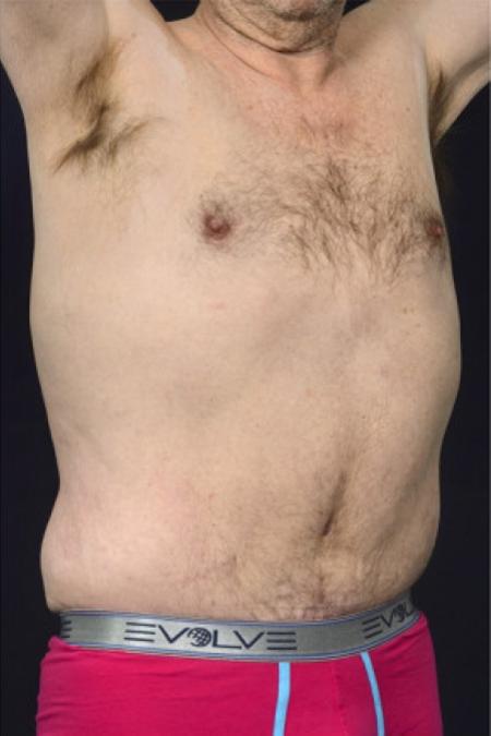 After image 1 Case #102946 - Abdominoplasty